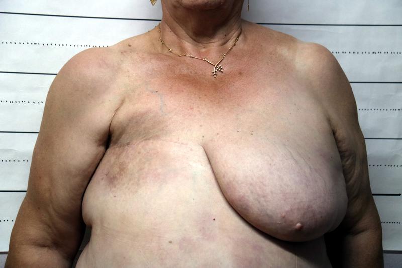 The body of a woman who has had breast cancer surgery