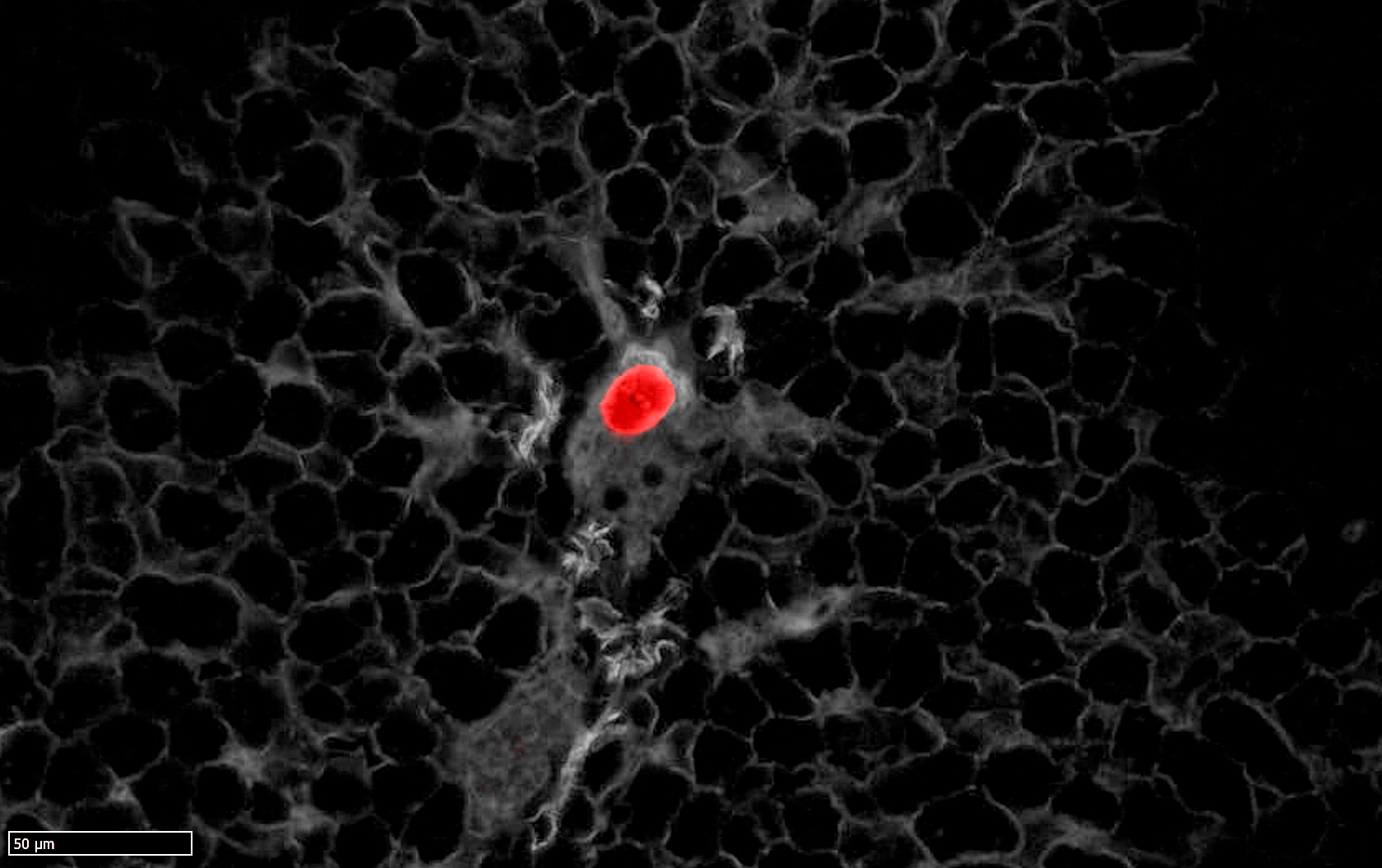 Extravasation of residual colorectal cancer tumor cell into a hepatic portal vein