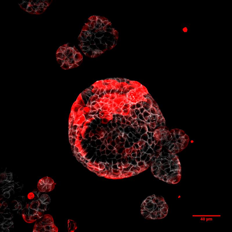 Colorectal cancer organoid with residual cells responsible for relapse marked in red